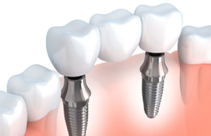 Immediate loading implantology