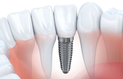 Implantology all on four/six