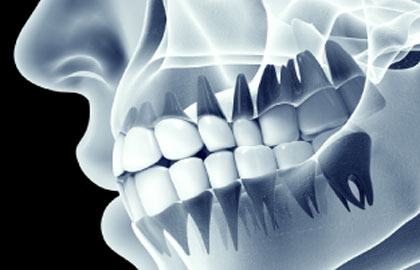 The benefits of 3D printing are numerous, and this method can definitely help any healthcare professional produce customized medical devices. Here are some examples of how dental 3D printing solutions specifically the use of dental modeling software and dental 3D printers can help improve the daily work of dentists, orthodontists and prosthodontists: 3D Printed Braces with LED Lights Researchers are developing “smart 3D printed braces”. The goal of these braces is to align and straighten teeth faster thanks to LED lights. These semi-translucent 3D printed braces place a battery on each tooth to power the light, as the energy actually helps the teeth move faster. In case you are wondering, no, light is not visible to the naked eye, it is a discrete process. The team’s researchers worked on non-toxic lithium batteries, but also on the flexible properties of these braces to make them safe and comfortable. These 3D printed braces are not yet available for public use, but they provide a nice glimpse into the research done in this sector. 3d Printed Dental Implants Additive manufacturing also has an important role in dental implant surgery. It is actually possible to create a 3D model to replace a missing tooth. 3D printing actually makes it possible to get a replacement tooth faster and with greater precision than traditional methods. It is also an easier and more economical method and the final product can have a really good finish. 3D printing and dental restoration have a bright future ahead of them.  3d Printed Dentures It is also possible to 3D print complete dentures with gums and teeth that must be printed with biocompatible materials. Even the base of the prosthesis is 3D printable and can be adapted to the patient’s morphology. For now, 3D printed dentures are only being created for clinical trials, but we expect it to be a common 3D printed product soon. 3d Printed Crowns Additive manufacturing makes it possible to produce crowns very quickly, as the dentist can perform the process himself. It is one of the most common applications of 3D printing in dentistry. It is possible to obtain a scan of the patient’s teeth, model it and directly print the crown. The process is really time-saving and a professional can adjust and reprint the crown if a mistake is made. Of course, this is not an exhaustive list of what you can 3D print in the dental industry, it is also possible to 3D print surgical instruments, night guards and so on.   3D printing can also be used by professionals themselves. It is possible to 3D print not only braces, biocompatible surgical guides, implants or crowns, but also tools. In this way, it is possible to perfectly adapt the device to work methods or processes. This method of tool production is applicable to the entire medical industry.